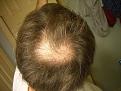 About 2 weeks before going on propecia. You can see how it is spreading upward