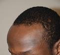 Before Surgical Hairline Advancement.