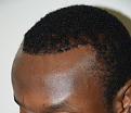 1 Week After Surgical Hairline Advancement.