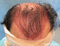 Scalp after the creation of 2,908 recipient sites - Top View

View his full photoset >> http://www.bernsteinmedical.com/hair-transplant-photos/portraits/patient-apl/