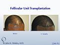 A 35-year-old African-American male underwent a 2200 FU session with Dr. Carlos K. Wesley (NYC).
