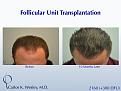 A 40-year-old male underwent a 2460 FU session of FUT with Dr. Carlos K. Wesley (NYC).