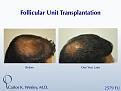 A 34-year-old male had 2579 FU added to his mid scalp to minimize his balding crown.