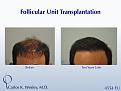 This 42-year-old man had two bad transplants at another office prior to coming to Dr. Wesley (NYC) for a revision of his hairline and subsequent mid scalp treatment.