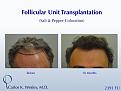 46-year-old male with curly hair of salt & pepper coloration underwent two sessions totaling 4637 FU with Dr. Carlos K. Wesley (NYC).