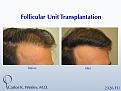 This 42-year-old man simply wanted a thicker hairline.  A 2326 FU session with Dr. Carlos K. Wesley (NYC) helped him accomplish his objective.