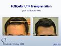 25-year-old male with 2034 FU session with Dr. Carlos K. Wesley for hairline fullness.