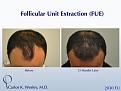 Before and 13 months after FUE with Carlos K. Wesley (NYC).