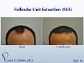 Before and 13 months after FUE with Carlos K. Wesley (NYC).