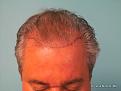 Frontal View Before Hair Transplant