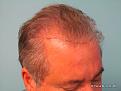 Right Side View Before Hair Transplant