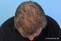 Top View After Hair Transplant