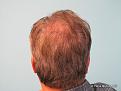 Back View Before Hair Transplant
