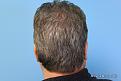 Back View After Hair Transplant