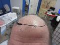 Before Hair Transplant
