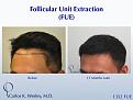 1352 FUE grafts to frontal region