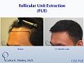1352 FUE grafts to frontal region