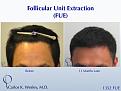 1352 FUE grafts to frontal region