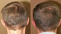 hair transplant before and after pictures