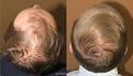 hair transplant before and after pictures