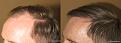 hair transplant before and after pictures