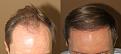 hair transplant before and after pictures 08