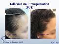 Female Hair Restoration