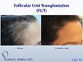 Female Hair Restoration