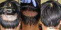 before , immediately after ARTAS and patient leaving the clinic after the procedure