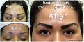 Brow restoration