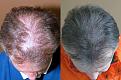 artas hair transplant before after 0040