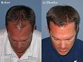 Paul Shapiro, MD
FUE 2073 grafts
1 year post op