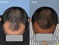 Dr. Paul Shapiro, MD 
Norwood 3A
2160 grafts
1 year post op