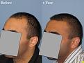 Dr. Paul Shapiro, MD 
Norwood 3A
2160 grafts
1 year post op