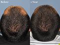 Dr. Paul Shapiro, MD 
Norwood 3A
2160 grafts
1 year post op