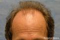Bernstein Medical's Patient JKJ before hair transplant - Detail of Hairline

View his full photoset >> http://www.bernsteinmedical.com/hair-transplant-photos/portraits/patient-jkj/