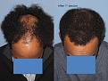 Paul Shapiro, MD
1st Session FUT = 2339 grafts
2nd Session FUT = 1706 grafts
Total for two = 4045 grafts