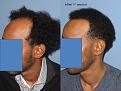 Paul Shapiro, MD
1st Session FUT = 2339 grafts
2nd Session FUT = 1706 grafts
Total for two = 4045 grafts