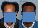 Paul Shapiro, MD
1st Session FUT = 2339 grafts
2nd Session FUT = 1706 grafts
Total for two = 4045 grafts