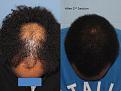 Paul Shapiro, MD
1st Session FUT = 2339 grafts
2nd Session FUT = 1706 grafts
Total for two = 4045 grafts