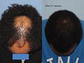 Paul Shapiro, MD
1st Session FUT = 2339 grafts
2nd Session FUT = 1706 grafts
Total for two = 4045 grafts