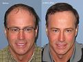 Paul Shapiro, MD
1st FUT session = 2669 grafts
2nd FUT session = 1876 grafts
Total both sessions = 4545 grafts
10 months post-op