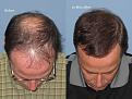 Paul Shapiro, MD
1st FUT session = 2669 grafts
2nd FUT session = 1876 grafts
Total both sessions = 4545 grafts
10 months post-op