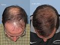 Paul Shapiro, MD
1st FUT session = 2669 grafts
2nd FUT session = 1876 grafts
Total both sessions = 4545 grafts
10 months post-op