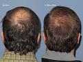 Paul Shapiro, MD
1st FUT session = 2669 grafts
2nd FUT session = 1876 grafts
Total both sessions = 4545 grafts
10 months post-op