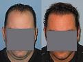 Dr. Paul Shapiro, MD
FUT 3390 grafts
12 months post-op