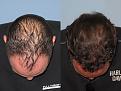 Dr. Paul Shapiro, MD
FUT 3390 grafts
12 months post-op