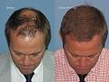 Dr. Paul Shapiro, MD
FUT 4348 grafts
6 months post-op