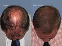 Dr. Paul Shapiro, MD
FUT 4348 grafts
6 months post-op