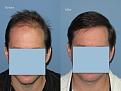 Dr. Paul Shapiro, MD
FUT 4365 grafts
12 months post-op